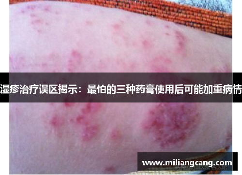 湿疹治疗误区揭示：最怕的三种药膏使用后可能加重病情